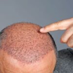When a Hair Transplant Turned Into a Medical Horror