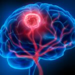 The headache that hid a tumour — And the diagnosis that came too late