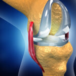 Leg lost after knee replacement — Commission finds no lapse in surgical care