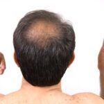 Simple case of hair fall gets into a legal tangle