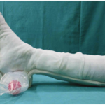 Court breaks the case of a doctor who didn’t treat fracture