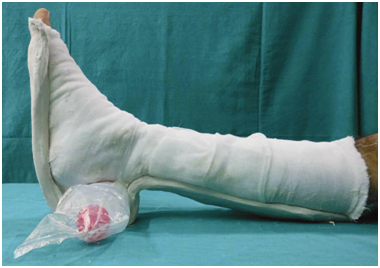 Court breaks the case of a doctor who didn’t treat fracture